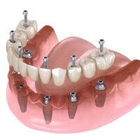 Mandibular prosthesis All on 4 system supported by implants, screw fixation. Medically accurate 3D illustration of dental concept